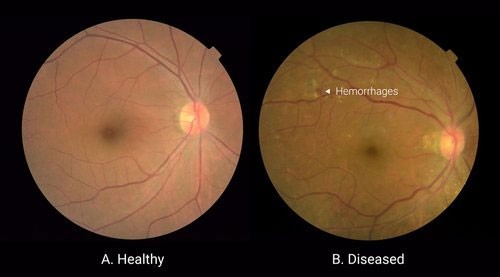 Esempi di fotografie della retina analizzate per questo tipo di patologia: a sinistra un occhio sano, a destra uno che presenta lesioni